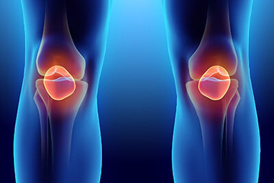 Torn Meniscus Stem Cell Treatment in Hayward, CA